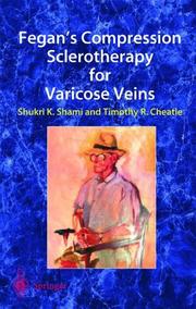 Fegan's compression sclerotherapy for varicose veins