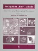 Malignant liver tumors : current and emerging therapies