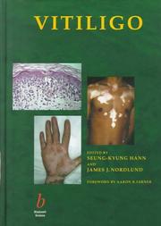 Cover of: Vitiligo by 