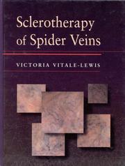 Sclerotherapy of spider veins by Victoria Vitale-Lewis