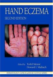 Cover of: Hand Eczema, Second Edition (Crc Series in Dermatology,) by 