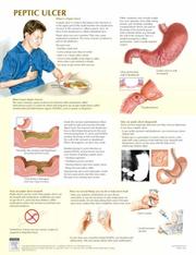 Cover of: Peptic Ulcer Chart (Netter Charts) by Frank H. Netter