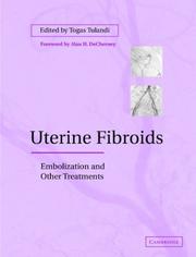 Cover of: Uterine Fibroids: Embolization and other Treatments
