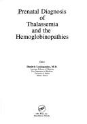 Prenatal diagnosis of thalassemia and the hemoglobinopathies