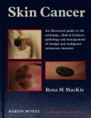 Skin cancer by Rona M. MacKie