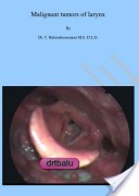 Cover of: Malignant tumors of larynx