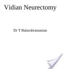 Cover of: Vidian Neurectomy