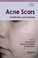 Cover of: Acne Scars Classification And Treatment