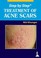 Cover of: Treatment Of Acne Scars