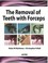 Cover of: Removal Of Teeth With Forceps The