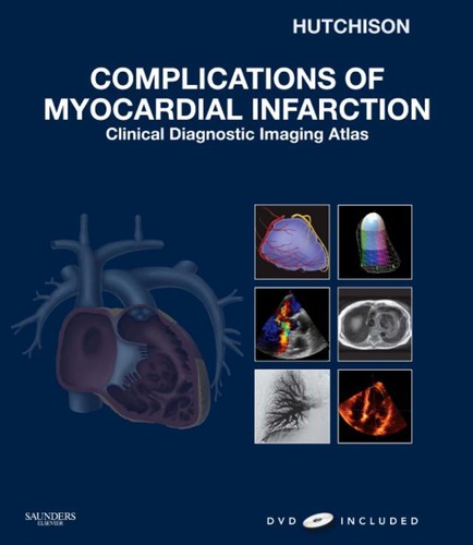Complications of myocardial infarction by Stuart J. Hutchison